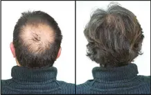  ??  ?? Breakthrou­gh research proves this discovery helps fill-in bald spots, re-nournishes thinning hair, and leads to noticeable growth in as little as 30 days.