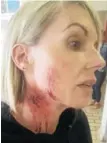  ?? Picture: SUPPLIED ?? INJURED: Lorraine de Wet was attacked in Grey Street and sustained injuries to her face and neck