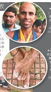  ??  ?? 「印度阿甘」辛赫（前）是5度超級馬拉松冠軍。（取材自100 Days of Running臉書專­頁）辛赫受水泡、疾病和受傷的折磨（左圓圖），放棄「百日跑1萬公里」壯舉（下圖）。（Getty Images）