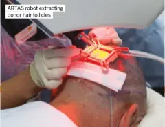  ?? ?? ARTAS robot extracting donor hair follicles