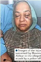 ?? ?? ●●Images of the injuries sustained by Shameem Akhtar in the alleged attack by a police officer