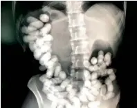  ??  ?? An X-Ray image shows the heroin packets concealed in the stomach of the suspect held at RAK Internatio­nal Airport.