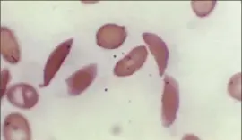  ?? Dr. F. Gilbert/CDC via AP ?? This microscope photo provided on Oct. 25, 2023, by the Centers for Disease Control and Prevention shows crescent-shaped red blood cells from a sickle cell disease patient in 1972.