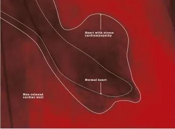  ??  ?? When a normal heart contracts, the left ventricle is flattened. But in patients with stress cardiomyop­athy, the heart is unable to fully contract.