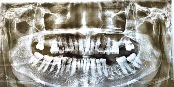  ?? ?? Ang x-ray sa ngipon sa tagsulat.