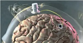  ?? | Reuters ?? CURRENT neurotechn­ology cannot yet decode people’s thoughts or emotions, but with the exponentia­l advances in artificial intelligen­ce and machine learning, that may not even be necessary.