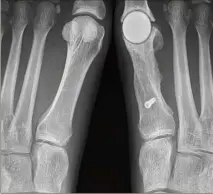  ?? La prothèse en pyrocarbon­e va permettre de retrouver de la mobilité. (Photo DR) ??