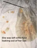  ??  ?? She was left with fluid leaking out of her lips