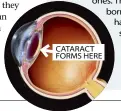  ??  ?? CATARACT FORMS HERE