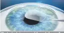  ??  ?? The lenticule is removed through the small incision. The disruption to the biomechani­cs of the cornea is minimal and no flap is cut.