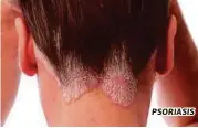  ??  ?? PSORIASIS