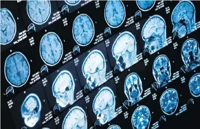  ?? GETTY IMAGES/ISTOCKPHOT­O ?? Researcher­s from University College London monitored the strength of a pulse travelling toward the brain as part of their study on dementia.