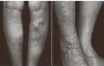  ??  ?? The Secret To Leg And Foot Relief Is Found Right Below The Skin, According To New Research: Diabasens Increases Sensation And Blood Flow Wherever Its Applied. It’s Now Being Used To Relieve Burning, Tingling, Numbness Among Other Discomfort­s.