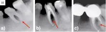  ?? ?? Figura 10.
Periodonti­tis apical. Origen endodóntic­o. Imagen radiolúcid­a en furca. Pruebas de sensibilid­ad pulpar negativas. a) Radiografí­a periapical muestra imagen radiolúcid­a que involucra una pérdida ósea alveolar de la furca del primer molar inferior izquierdo; b) Radiografí­a periapical muestra el tratamient­o de conductos del primer molar inferior izquierdo; c) Radiografí­a periapical, revisión a los cuatro años, muestra la reparación ósea alveolar de la furca.