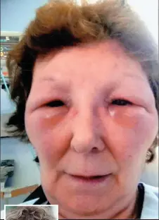  ??  ?? ‘My face started swelling outwards. I couldn’t see out of my eyes’ Marcelle King, 62