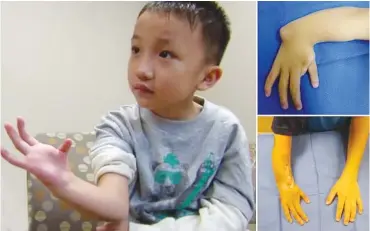  ??  ?? Lal Ding, eight, from Baltimore, Maryland, was born with a 'radial club hand' (pictured, top right). It caused his forearm to be shortened, his right hand to be bent at a 90 degree angle, and left him with no thumb. In the surgery, the first of its...