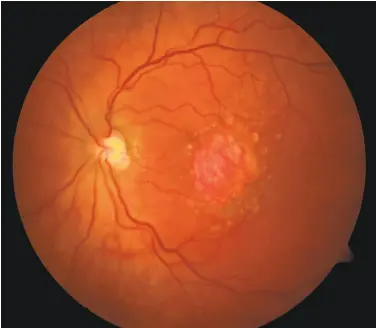  ?? National Eye Institute ?? A microscopi­c image from the National Eye Institute shows a retina being damaged by the dry form of age-related macular degenerati­on, a disease that can blind older adults.