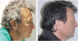  ??  ?? Before and after photos of one of the cancer patients with grey hair that turned dark while taking new immunother­apy drugs.