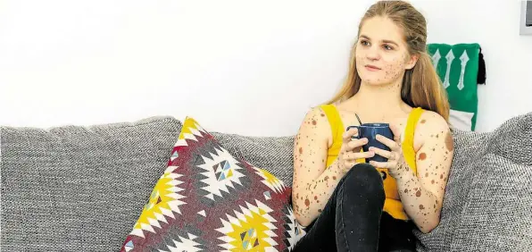  ?? BILDER: CLAUS H2CK ?? Marika .agy hat die Pigmentstö­rung „Kongenital­er .ävus“. Auf Instagram erzählt die 21-Jährige über ihr Leben.
