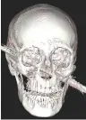  ?? (Hadassah) ?? AN IMAGE of the skull of Kamel Abdel Rahman, who two weeks ago survived falling onto an iron rod that penetrated through his head.