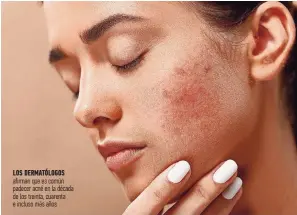  ?? ?? LOS DERMATÓLOG­OS afirman que es común padecer acné en la década de los treinta, cuarenta e incluso más años