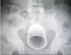  ??  ?? IMBASAN x-ray menunjukka­n kedudukan cawan itu di dalam badan pesakit. - Daily Mail