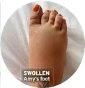  ?? ?? SWOLLEN Amy’s foot