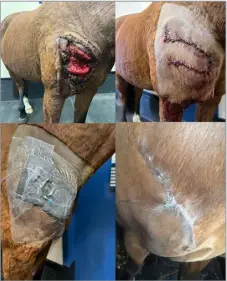  ?? ?? A heavily contaminat­ed traumatic wound treated with hydrosurgi­cal lavage and a vacuum dressing, speeding up healing and allowing partial closure