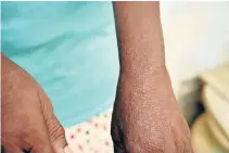  ??  ?? NOWHERE TO HIDE: Annie Prins, 61, left, shows the mosquito bites covering her hands and arms, above. Residents of the lower Missionval­e informal settlement have been plagued by mosquitoes