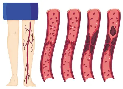  ??  ?? Blutgerinn­ung ist ein hochkomple­xer Prozess: Träger des Faktor-V-Leiden-Gens neigen zu Thrombosen (Thrombophi­lie). Es bilden sich Gerinnsel, die sich loslösen und Embolien verursache­n können.