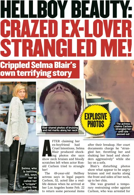  ?? ?? Selma, who is battling MS, says
her ex called her a “cripple” during the
attack
Blair shared photos of bruising and red marks along her neck
The actress claims Carlson strangled her until she passed out