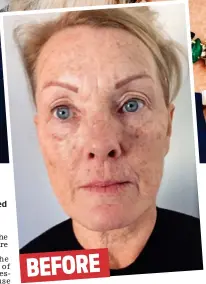  ??  ?? No regrets: Betty Bo, 60, says she looks a decade younger after horse collagen was used to fill in her wrinkles BEFORE