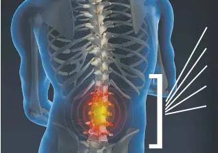  ??  ?? Bulged Disc Herniated Disc Sciatica Pinched Nerves Stenosis