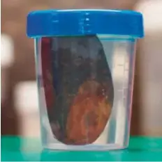  ??  ?? The gallstone measuring 7cm that was extracted from a 52-year-old Iraqi expatriate woman in Dubai.