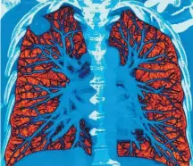  ?? VOISIN/SCIENCE SOURCE ?? Pulmão. IA pode ler tomografia­s e ajudar a confirmar casos