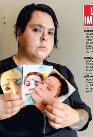  ?? PHOTO LE JOURNAL DE QUÉBEC, DANIEL MALLARD ?? Katy Bolduc subira deux autres opérations au visage et une au coude. Elle est déjà passée sous le bistouri à quatre reprises. « Chaque fois, mon visage est dans un mauvais état », dit celle qui a eu 70 points de suture.