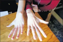  ??  ?? Sisters, Leanna Hall, 26, left, and Nadjezda Lof, 23, show off their similar hands.