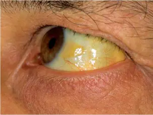  ??  ?? Ojo con el amarillo. La ictericia torna amarillent­os la piel y los ojos. Su causa es la acumulació­n de bilirrubin­a, una sustancia producida por el hígado, el primer órgano al que se suelen propagar los tumores del páncreas. Es uno de los síntomas...