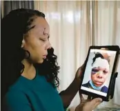  ?? LYNNE SLADKY/AP ?? LaToya Ratlieff looks at a photograph of herself in Lauderhill on June 12, 2020. Ratlieff was hit in the face by a police officer’s rubber bullet during a Fort Lauderdale protest over the death of George Floyd on May 31.