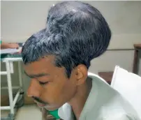  ?? IANS ?? The patient from Uttar Pradesh, who carried the World’s largest brain tumour, before the surgery. —