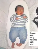  ??  ?? Rocco as a baby with his club foot