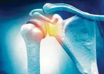  ?? IStockphot­o ?? Frozen shoulder is caused by inflammati­on of the joint capsule, the ligaments and the lining of the joint. The usual treatment is physical therapy. It rarely requires surgery.