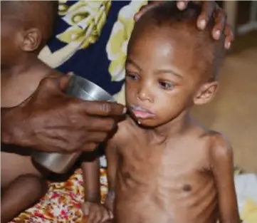  ??  ?? A malnourish­ed child being fed