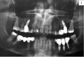  ??  ?? 3 Figura 3: Ortopantom­ografía dónde se visualiza la pieza 47, pilar posterior de puente metal porcelana de tres piezas, pieza fracturada, endodoncia­da y con imagen radiolúcid­a apical. Figura 4: Radiografí­a periapical preoperato­ria.