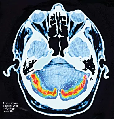 ?? ?? A brain scan of a patient with early-stage dementia