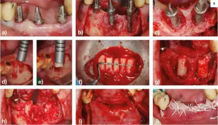  ??  ?? Figura 9. a) Imagen clínica preoperato­ria. b) Imagen clínica vestibular de la patología periimplan­taria. c) Imagen clínica oclusal de la patología periimplan­taria. d) Obtención de bloques de hueso autólogo mediante trefina. e) Obtención de bloques de hueso autólogo mediante trefina. f) Medición de los bloques obtenidos. g) Adaptación de los bloques a los defectos óseos posterior a la explantaci­ón de los implantes. h) Fijación de los bloques. i) Colocación de una membrana reabsorbib­le. j) Sutura y cierre. 9