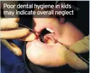  ??  ?? Poor dental hygiene in kids may indicate overall neglect