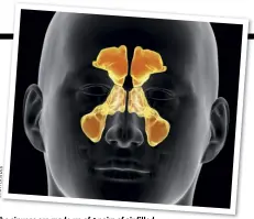  ??  ?? The sinuses are made up of 4 pairs of air-filled cavities in the facial bones.