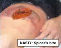  ??  ?? NASTY: Spider’s bite