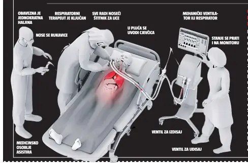  ??  ?? USPAVAJU PACIJENTA I PROVUKU CJEVČICU DO PLUĆNIH KRILA Kako bi se pacijent mogao staviti na respirator, odnosno uređaj za umjetno disanje, prije ga je nužno intubirati. To znači uvesti kroz nos ili usta cjevčicu koja je priključen­a na uređaj. Pacijent se prvo uspava, nakon čega mu se cijev provede do plućnih krila. Suvremene naprave tad održavaju pozitivni i negativni tlak potreban za disanje u fiziološki­m granicama kako ne bi došlo do oštećenja pluća.